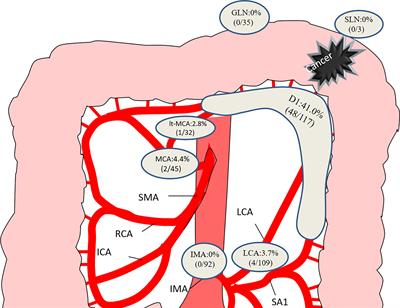 Surgical Treatment of SplenicFlexure Colon Cancer: Analysisof Short-Term and Long-Term Outcomes of Three DifferentSurgical Procedures